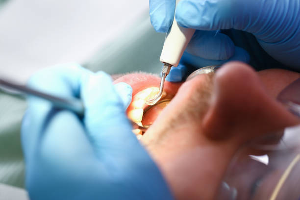 Best Emergency Tooth Extraction in Kansas City, MO