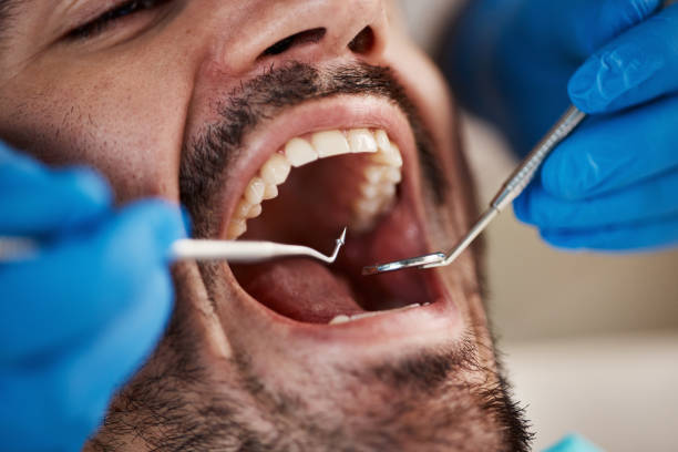Best Emergency Wisdom Teeth Removal in Kansas City, MO